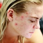 Isotretinoina nel trattamento dell'acne