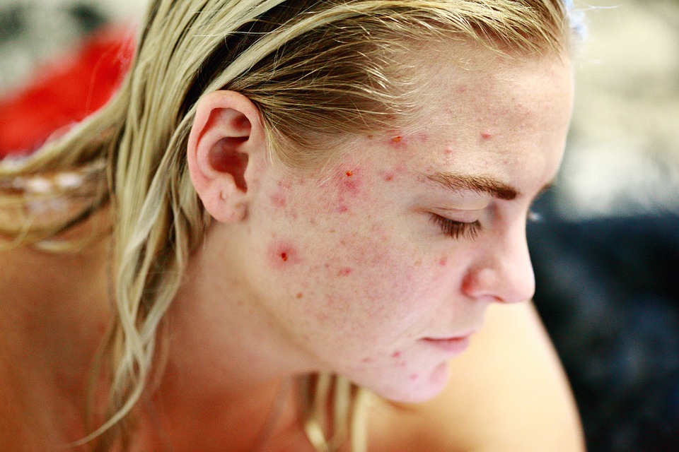 Isotretinoina nel trattamento dell'acne