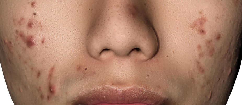Linee guida sul trattamento dell’acne