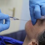 ago o cannula per i filler