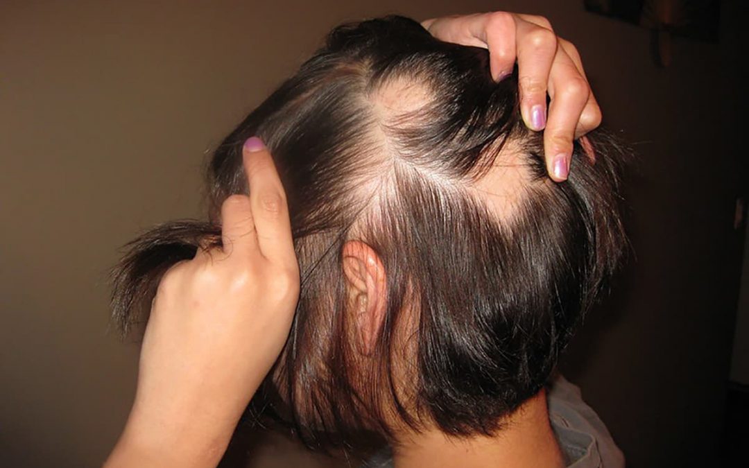 Alopecia areata: allo studio una nuova terapia