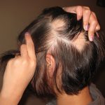 Alopecia areata: allo studio nuova terapia