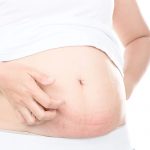Psoriasi in gravidanza: 10 domande