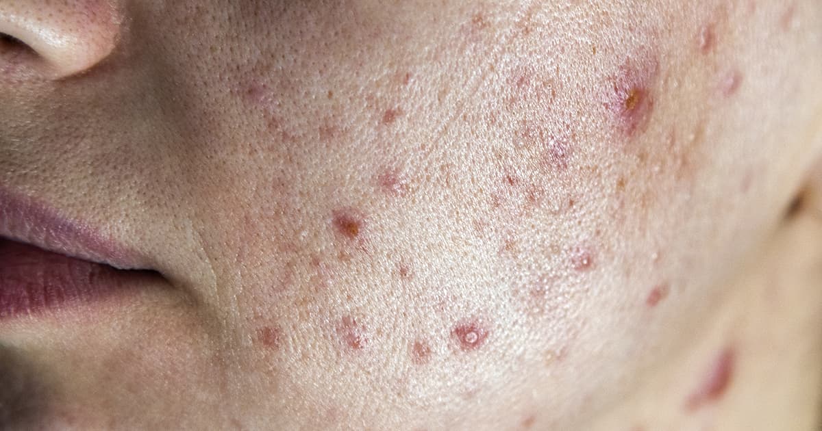 Isotretinoina Gel Prezzo